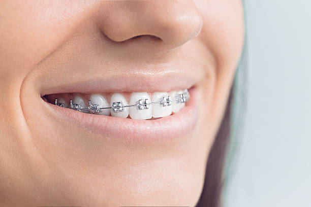 Best Veneers and Lumineers  in Fort Wayne, IN